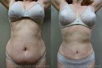 Abdomen Liposuction 3D Micro Lipo™ Results San Jose