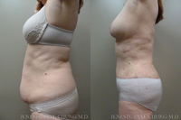 Abdomen Liposuction 3D Micro Lipo™ Results San Jose
