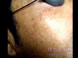 Laser Peel