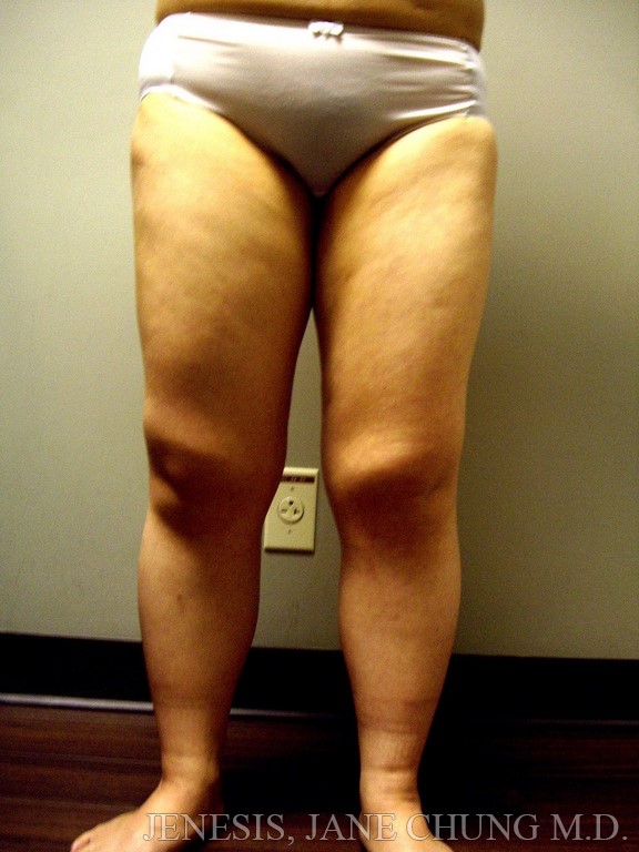 Thighs, Calves, and Ankles Liposuction