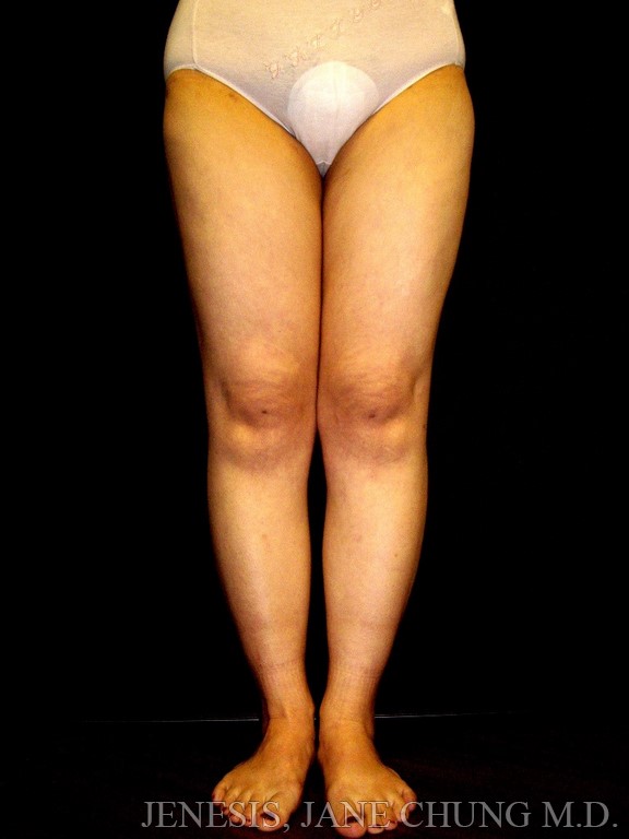 Thighs, Calves, and Ankles Liposuction