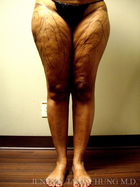 Thighs, Calves, and Ankles Liposuction