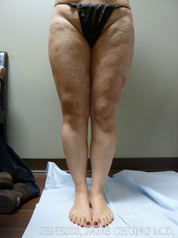 Thighs, Calves, and Ankles Liposuction