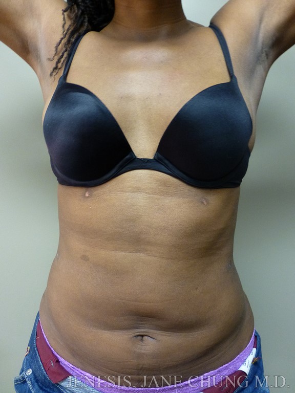 Revision Liposuction