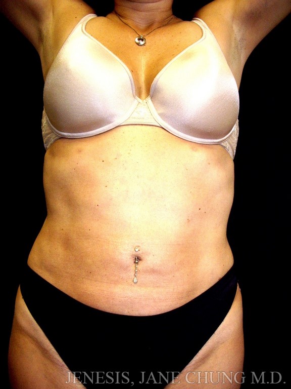 Revision Liposuction