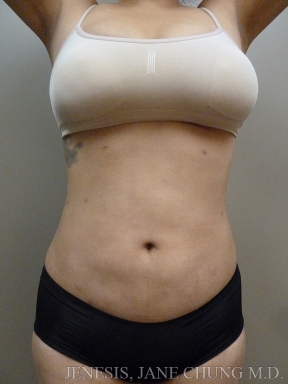 Revision Liposuction