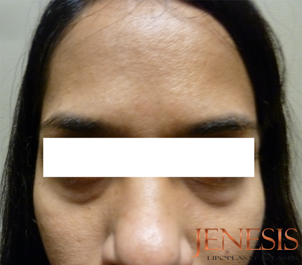 Non-surgical Dark circle removal with Filler