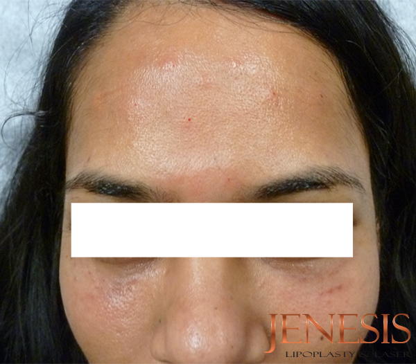 Non-surgical Dark circle removal with Filler