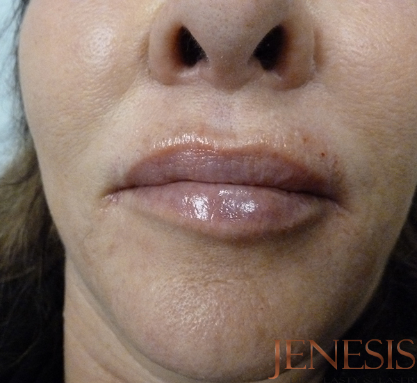 Juvederm