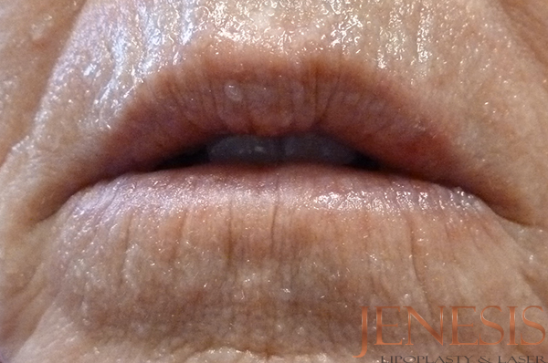 Juvederm