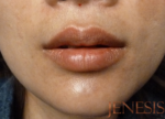 Juvederm