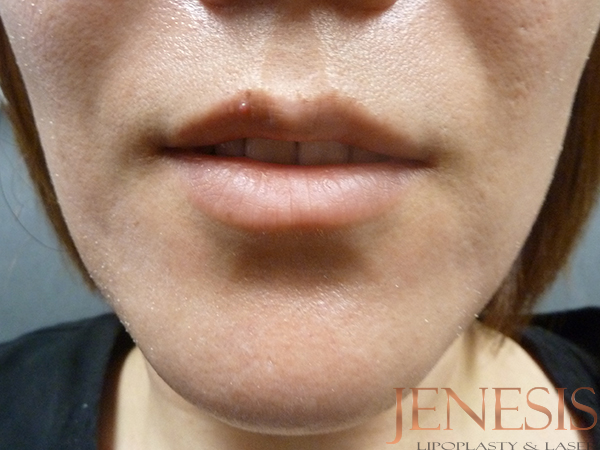 Juvederm