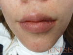 Juvederm