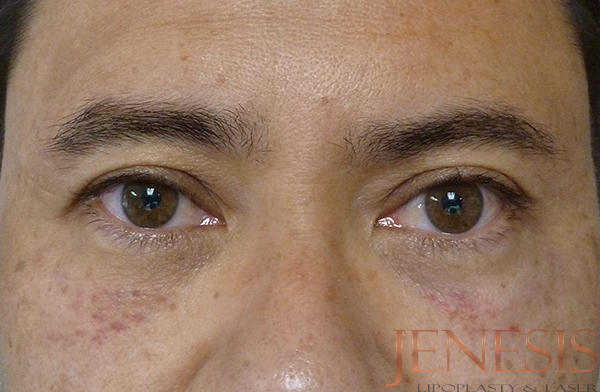 Non-surgical Dark circle removal with Filler