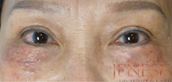 Non-surgical Dark circle removal with Filler