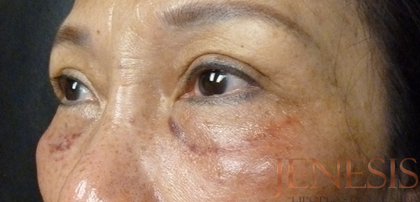 Non-surgical Dark circle removal with Filler