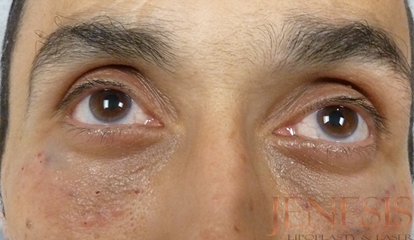 Non-surgical Dark circle removal with Filler